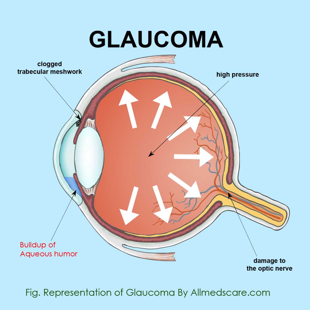 What is Glaucoma? Cause and Cure of Glaucoma - Allmedscare.com